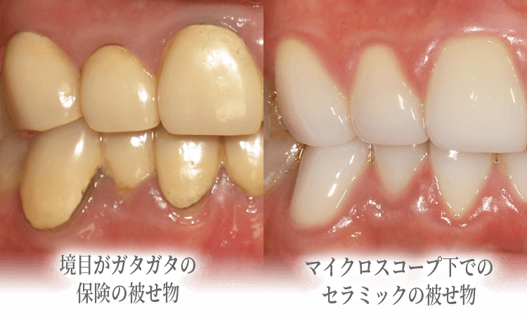 精密審美歯科治療