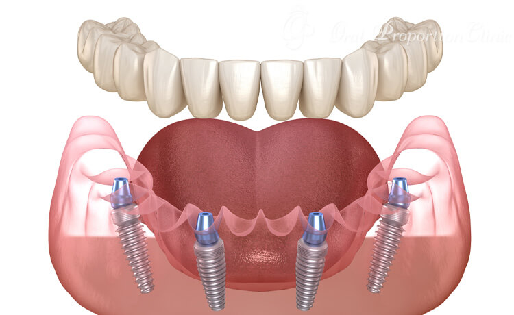 少ないインプラントで人工歯を支えるオールオン4（インプラント）