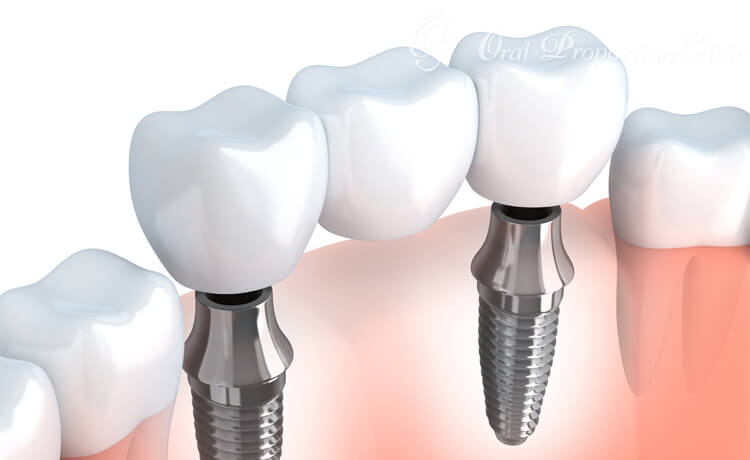 インプラントで複数の人工歯を固定する