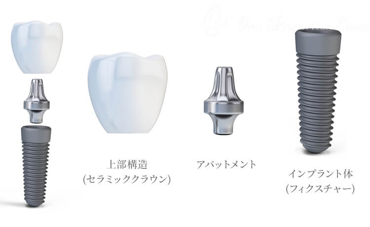 2ピースタイプのインプラント