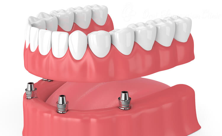 インプラントで入れ歯を支えるインプラントオーバーデンチャー(インプラント)