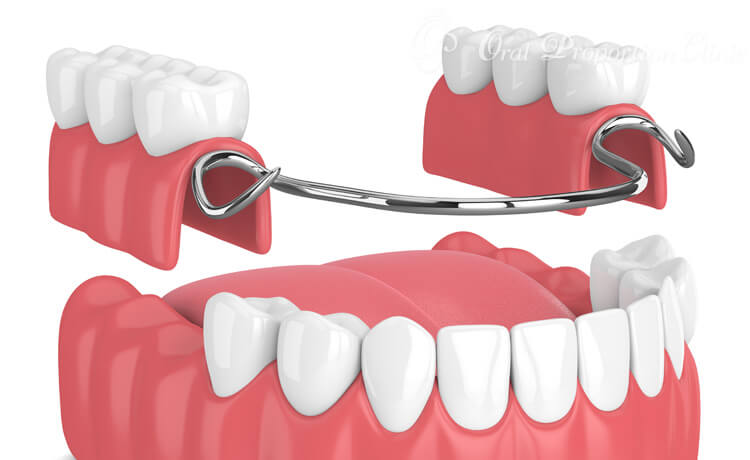 両隣の歯をバネで固定する部分入れ歯