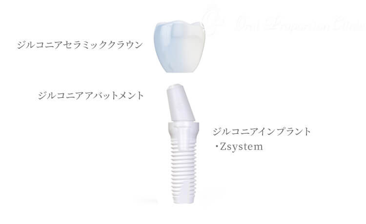 オールジルコニアインプラント