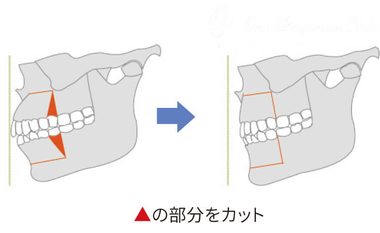 セットバック