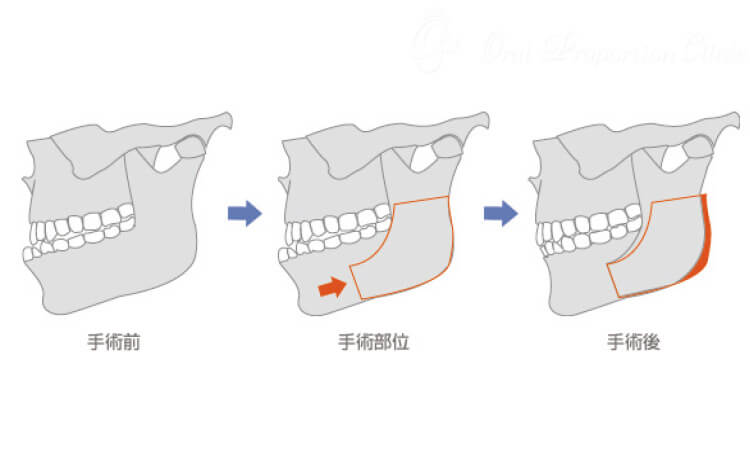 下顎枝矢状分割術