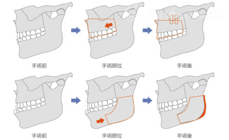 下顎枝矢状分割術＋Le FortⅠ型（ルフォーⅠ型）