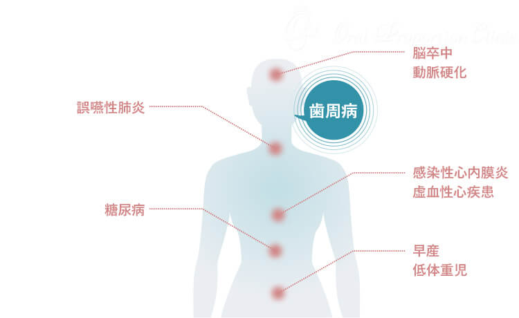 歯周病と全身疾患