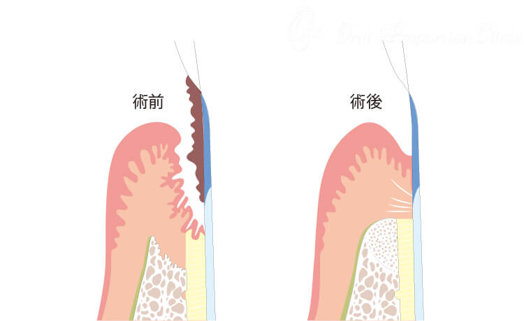 歯周組織再生療法（GTR法）