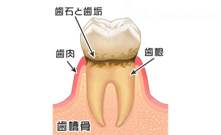 歯周炎