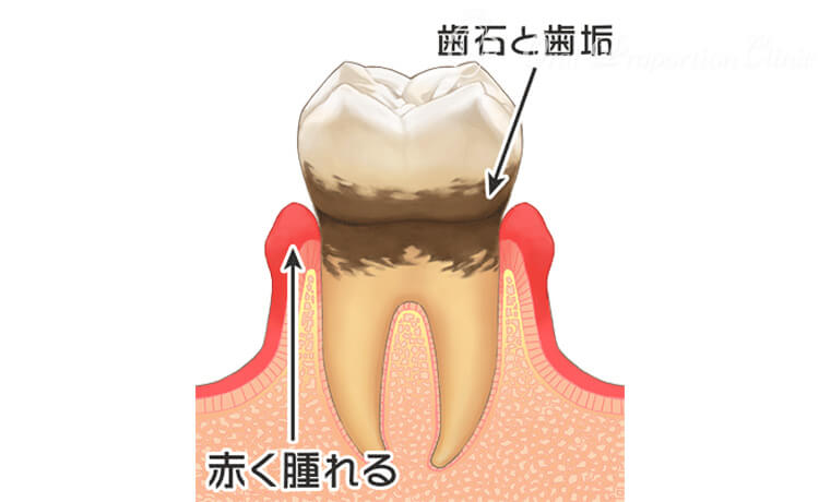 軽度歯周病