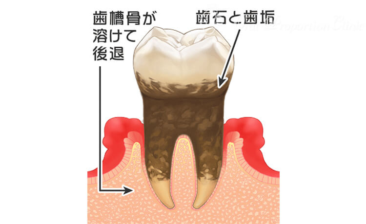 中度歯周病