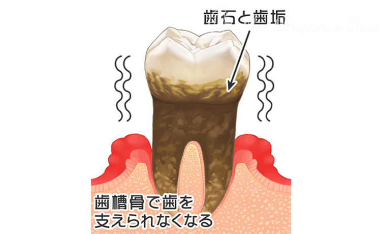 歯周病治療｜東京での無痛歯科治療｜オーラルプロポーションクリニック