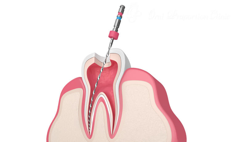 根管治療専用機器等を使用