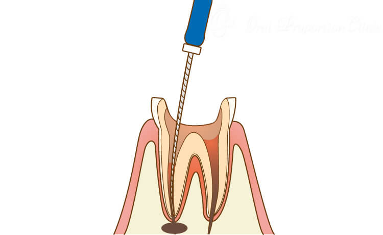 汚染された歯髄の除去