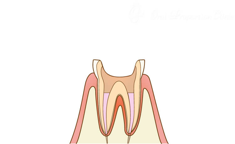 消毒薬を注入