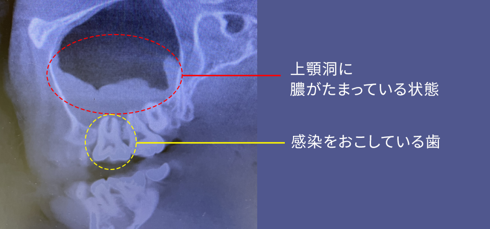 根管術前