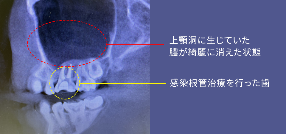 根管術後