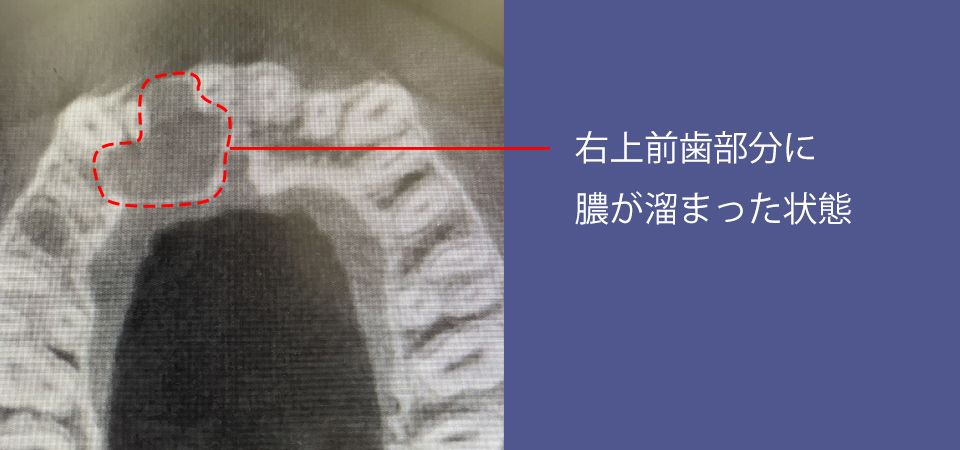 歯根端切除術前、膿が溜まった状態