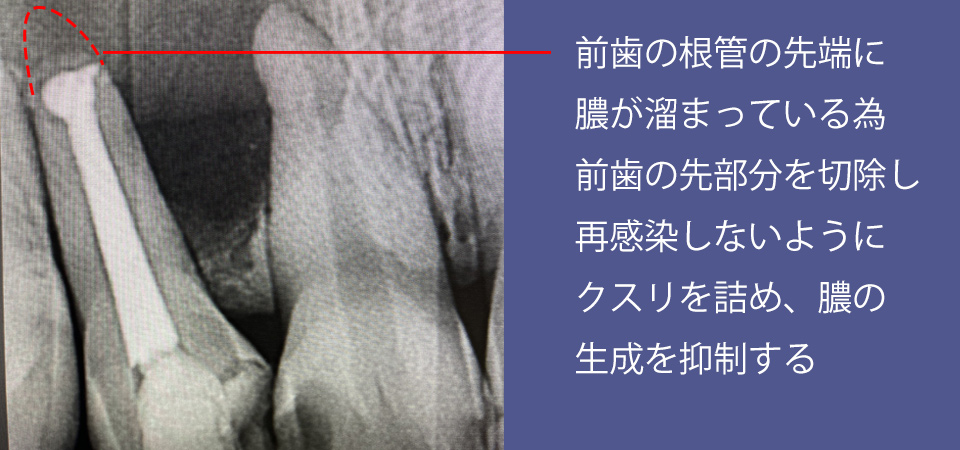 歯根端切除術