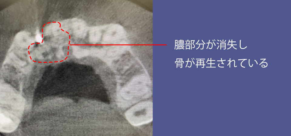 歯根端切除術後の経過、膿の消失