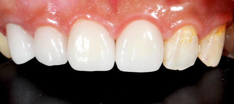 オールジルコニアクラウン前歯4本症例（治療後）