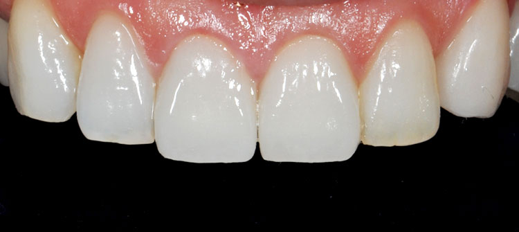 ジルコニアセラミッククラウン前歯2本（治療後）