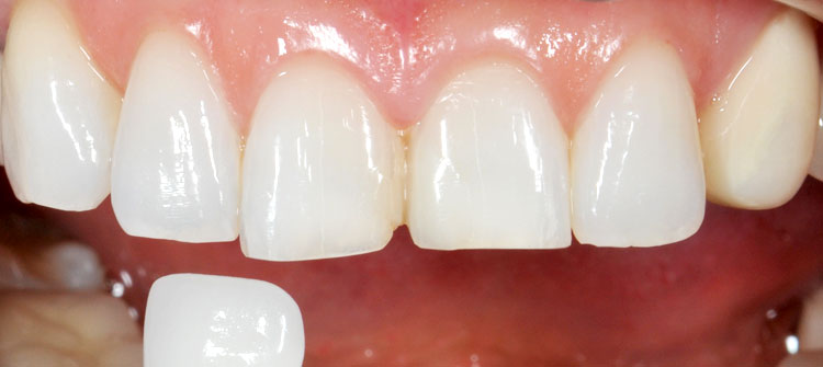 ジルコニアセラミッククラウン前歯2本（治療前）