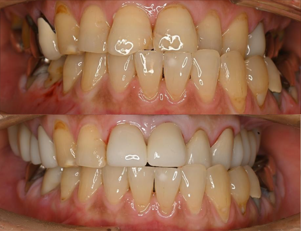 インプラント・セラミックの症例