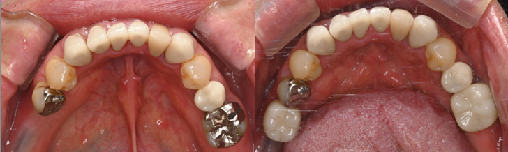 インプラントの症例