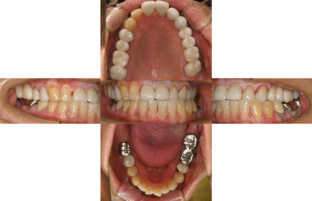 インプラント・セラミックの症例の術後