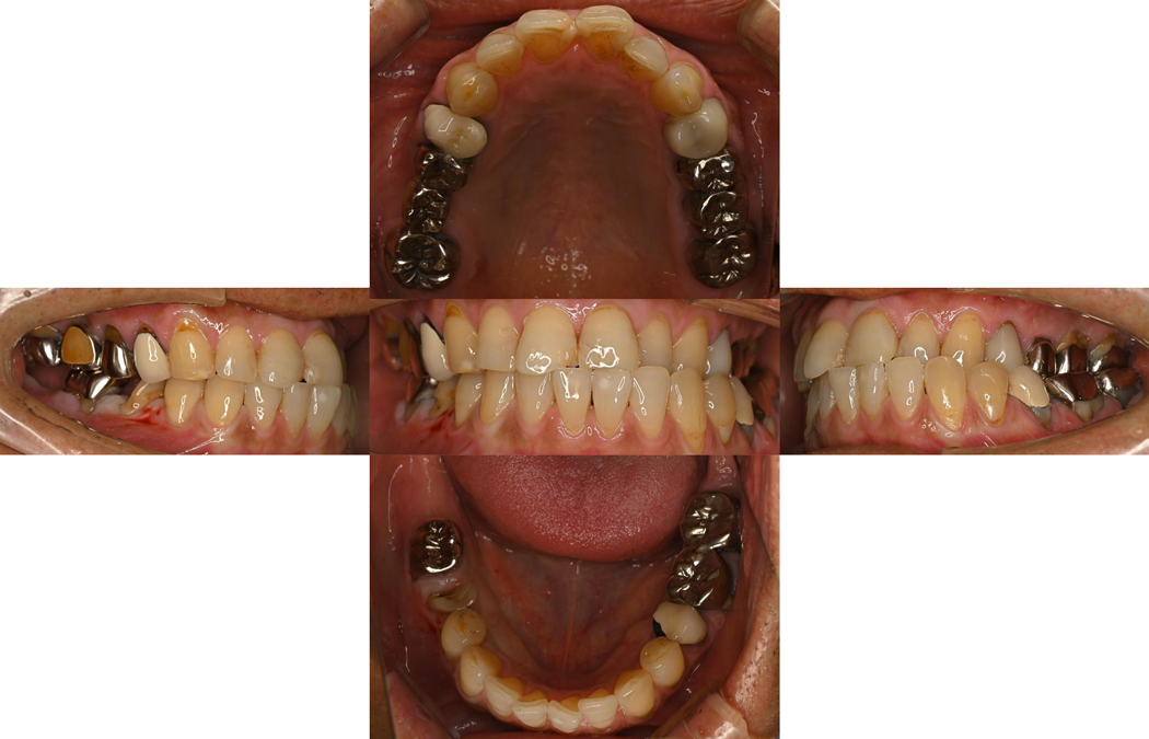 インプラント・セラミックの症例の術前